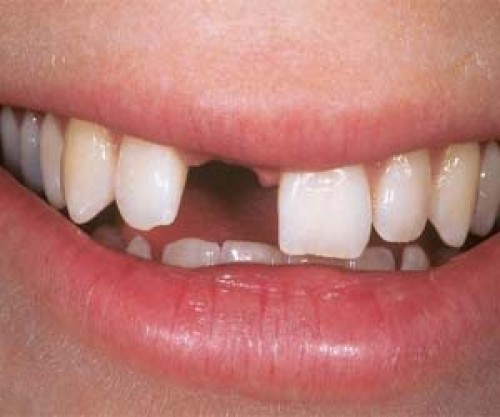 Utrata zębów fatalna w skutkach dla twojego zdrowia