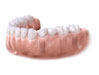 implanty zębów: brak kilku zębów