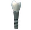 implanty zębów: korona